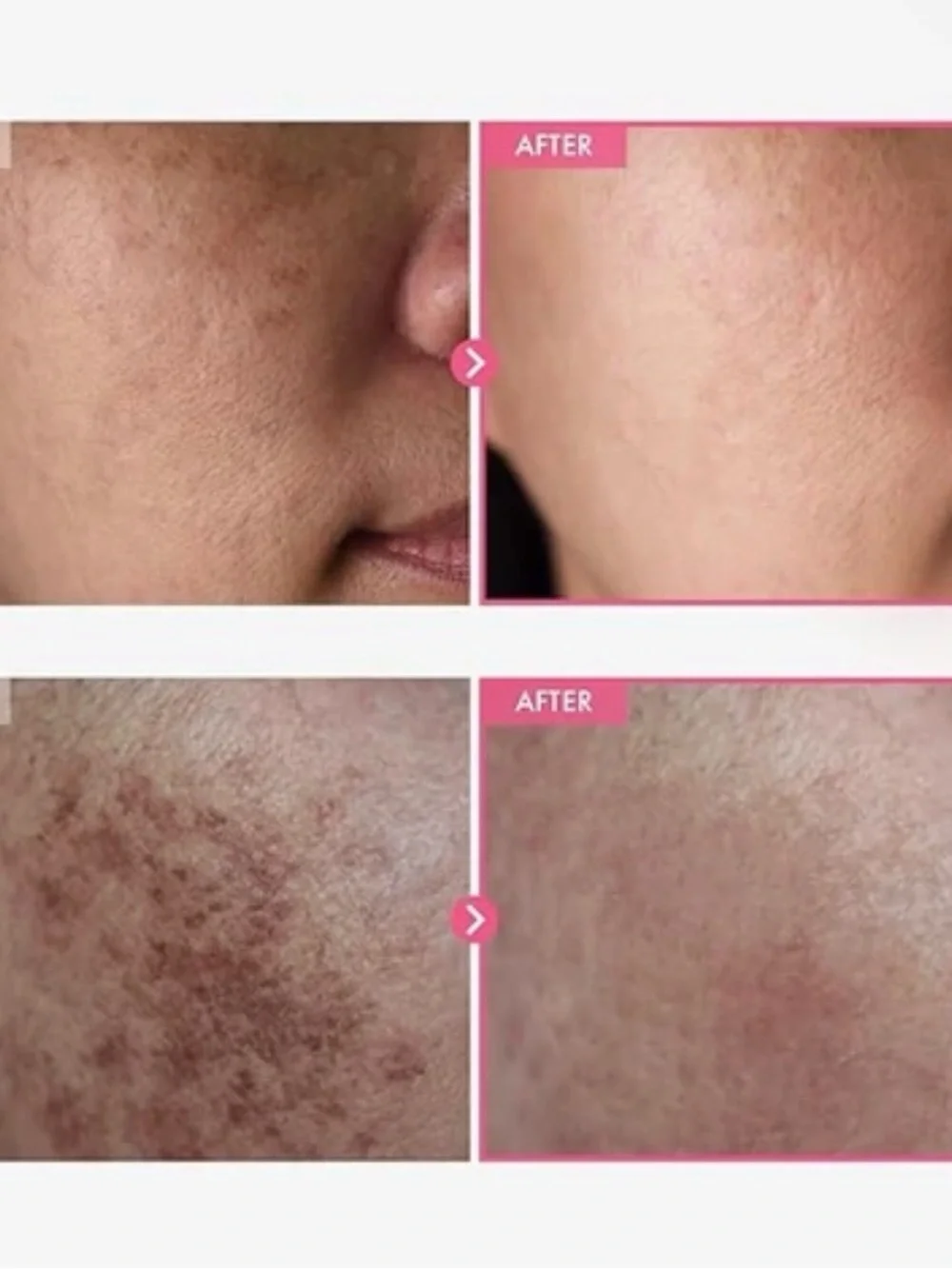 Evens out red skin Arbutin 7% tranexamic acid 4% cream - Brightening Treatment